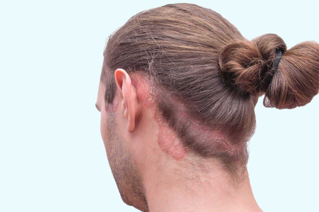 Scalp psoriasis exacerbation on back of man's head and scalp. 