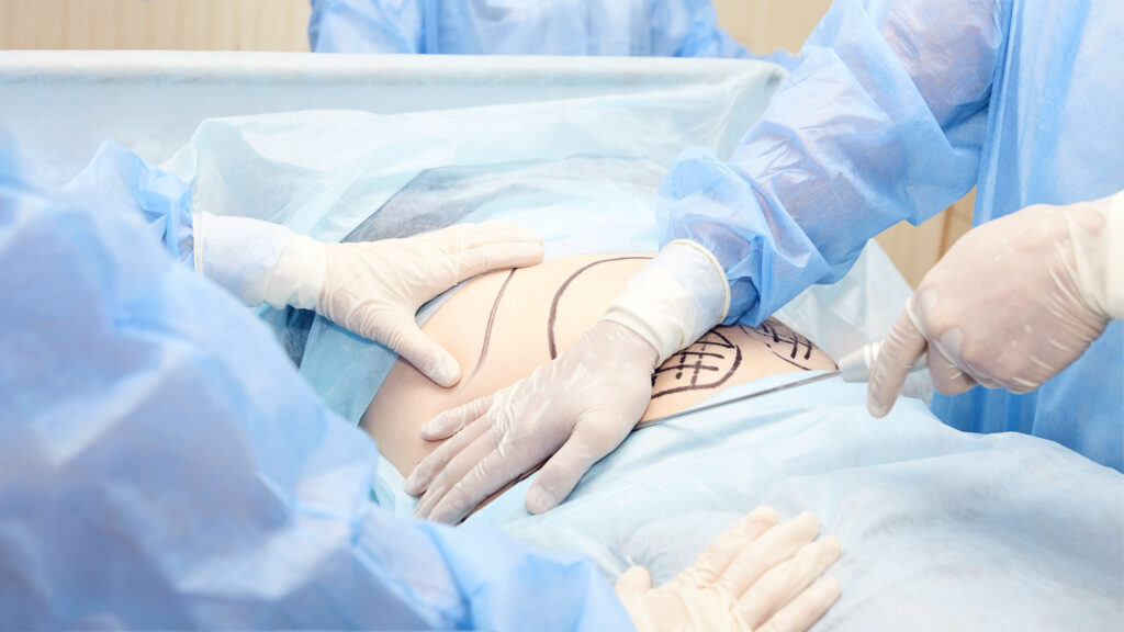 Doctor marking liposuction area at tummy. 