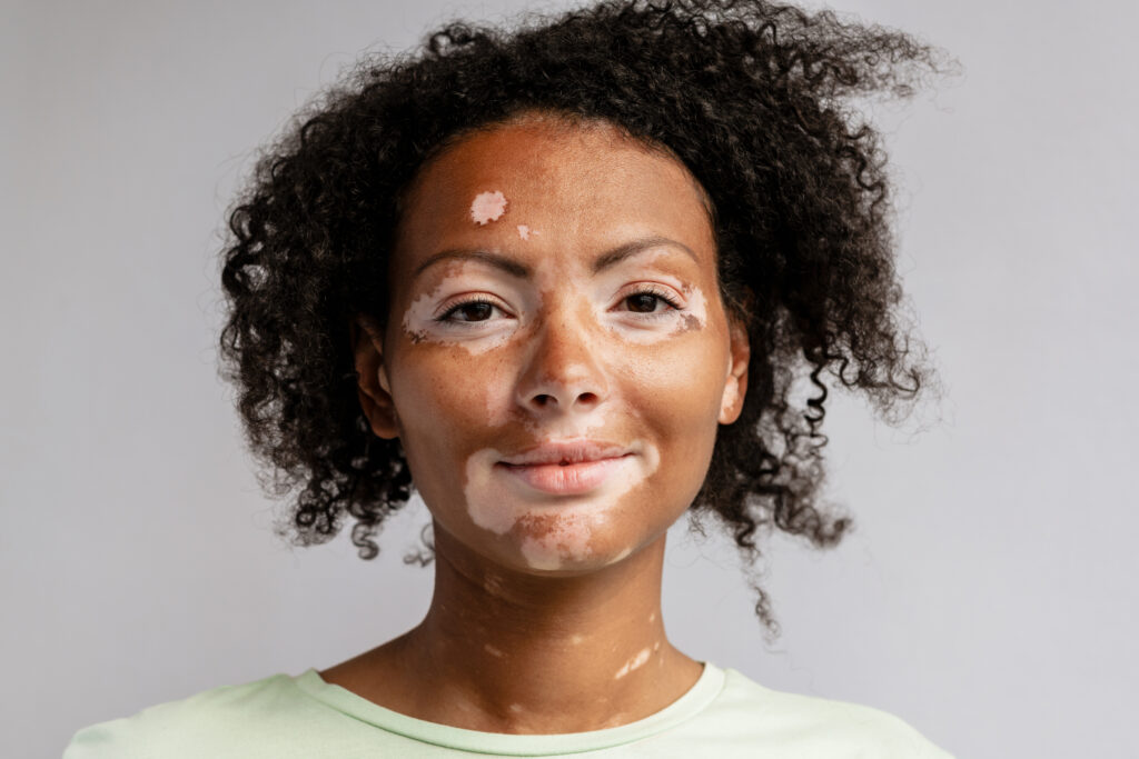 Young woman with vitiligo posing while looking at camera isolated over white wall