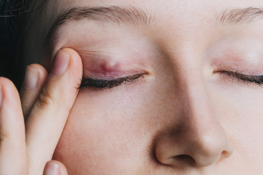 Woman with a stye on her upper eyelid, closeup