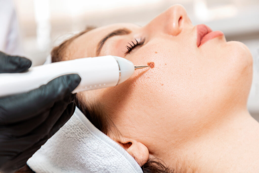 Professional salon procedures. Surgeon using a laser device for removing mole. 