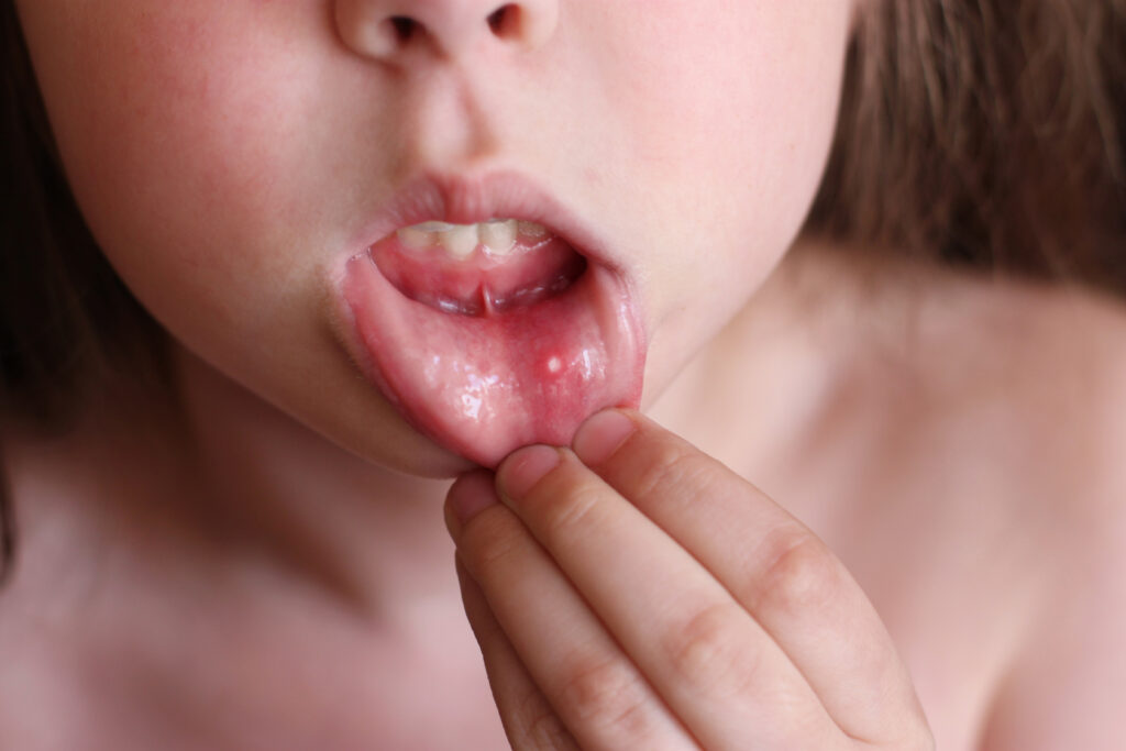Canker sore on the inner lip of a woman