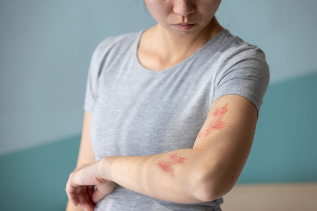 Woman with hives on her arm